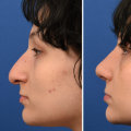 The Ideal Age for a Nose Job: Insights from a Plastic Surgery Expert