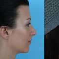 The Truth About Nose Humps and Rhinoplasty