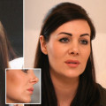 The Truth About Rhinoplasty and Aging