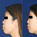 The Truth About Permanent Nose Jobs: Insights from a Plastic Surgeon
