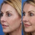 The Art of Rhinoplasty: How to Avoid Bad Nose Jobs