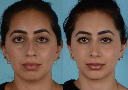 The Truth About Rhinoplasty: What to Expect and How to Choose the Right Surgeon