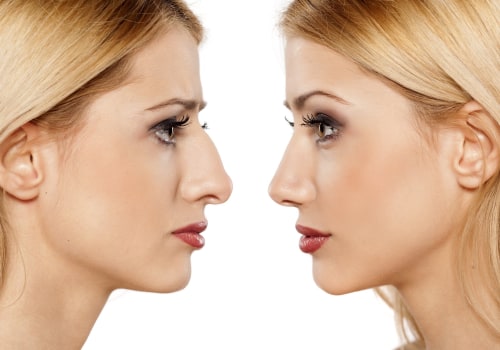 The Secret to Long-Lasting Results: Understanding the Longevity of a Nose Job