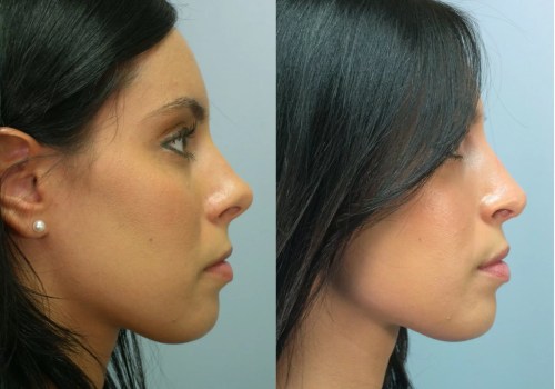 The Truth About Insurance Coverage for Rhinoplasty