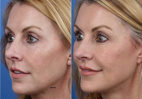 The Truth About Rhinoplasty: Why Revision Surgery May Be Necessary