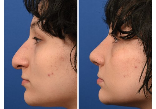 The Timeless Results of Rhinoplasty: How Nose Jobs Age Gracefully