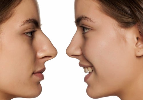 What happens to a nose job after 10 years?