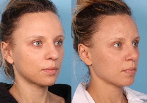 The Truth About Long-Term Results of Rhinoplasty